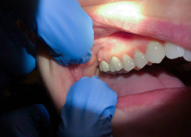 Best Emergency Treatment for Dental Infections or Abscesses in Arlington, TX